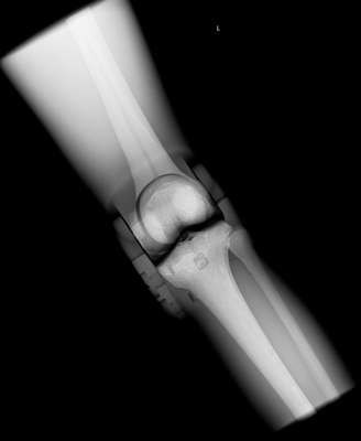 Sectional X-ray phantom with artificial bones - Right Knee, opaque_0
