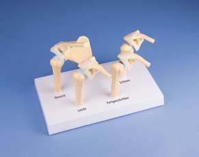 4-stage Osteoarthritis (OA) Shoulder_0